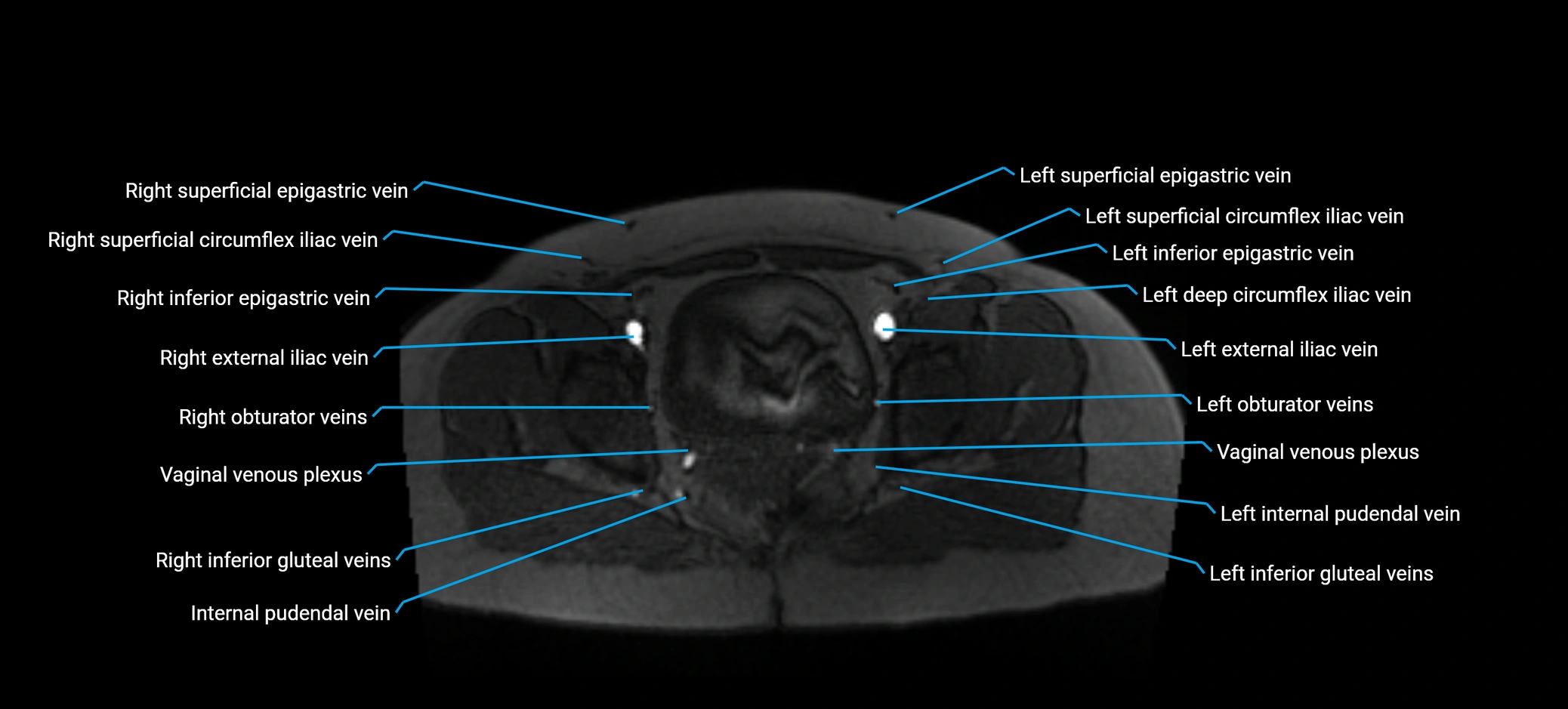 MRV abdomen pelvis & lower limb axial cross sectional anatomy labelled MRI image 173 (1).webp